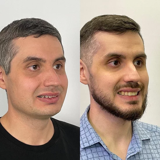 Лицо пациента до и после, ракурс 2