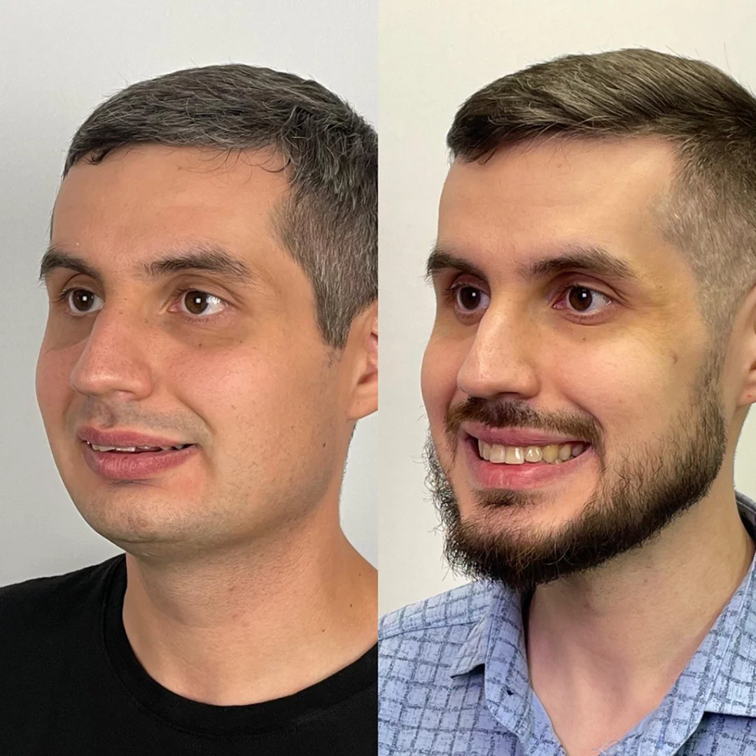 Лицо пациента до и после, ракурс 1