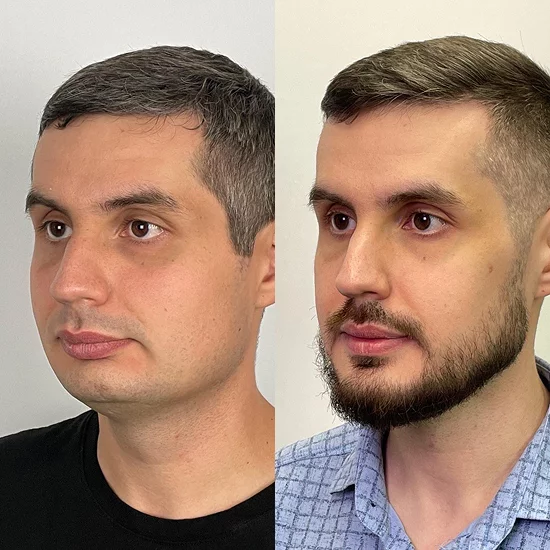 Профиль пациента до и после, ракурс 4