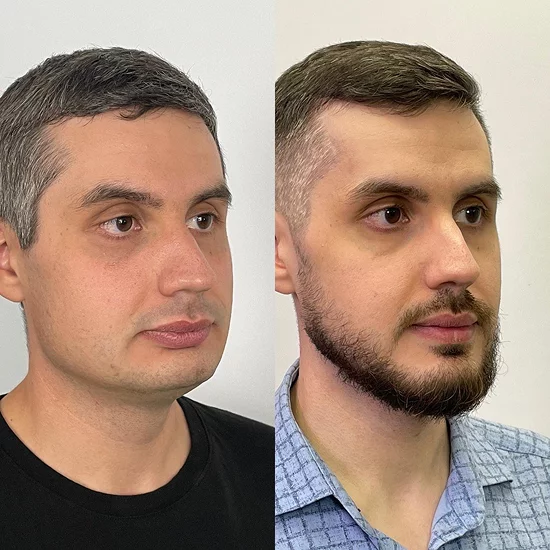 Профиль пациента до и после, ракурс 3